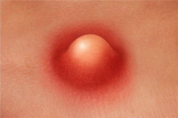 火癤子有了白點(diǎn)可以擠破嗎 火癤子可以刺破嗎 火癤子有了白點(diǎn)可以擠破嗎 火癤子可以刺破嗎