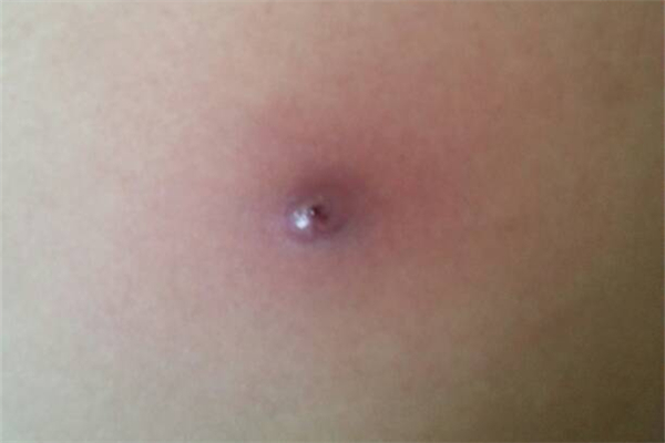 火癤子怎么治療最快 火癤子是什么引起的 火癤子怎么治療最快 火癤子是什么引起的