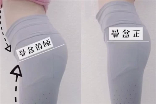 骨盆前傾的癥狀有哪些表現(xiàn) 骨盆前傾的原因 骨盆前傾的癥狀有哪些表現(xiàn) 骨盆前傾的原因