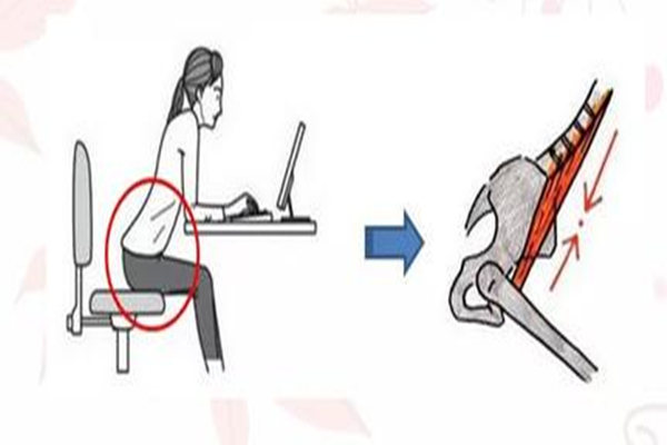 骨盆前傾有必要矯正嗎 骨盆前傾對身體的危害 骨盆前傾有必要矯正嗎 骨盆前傾對身體的危害