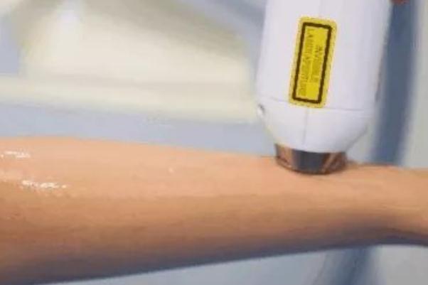 激光脫毛的注意事項 激光脫毛的副作用有哪些 激光脫毛的注意事項 激光脫毛的副作用有哪些