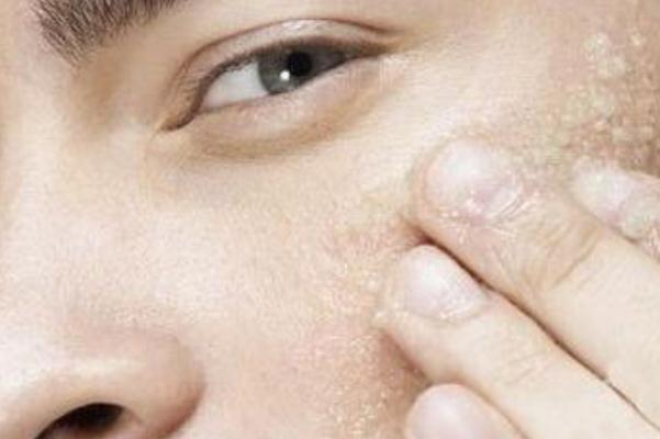 去角質(zhì)是什么意思 去角質(zhì)是干臉用還是濕臉用 去角質(zhì)是什么意思 去角質(zhì)是干臉用還是濕臉用