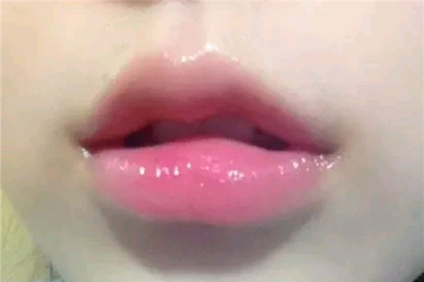 豐唇需要打幾支玻尿酸 豐唇需要打麻藥嗎 豐唇需要打幾支玻尿酸 豐唇需要打麻藥嗎