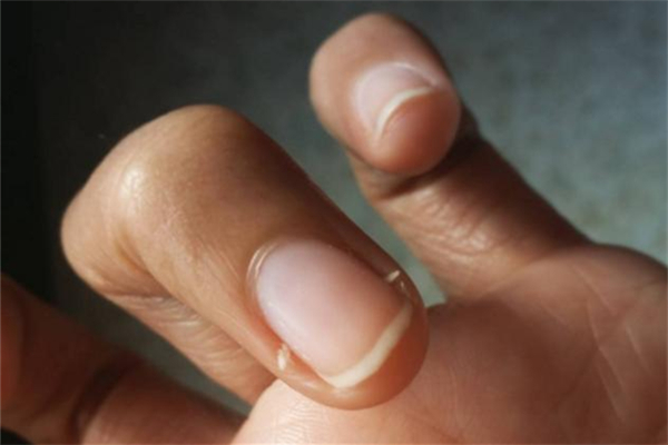 倒刺可以撕?jiǎn)?倒刺拔了會(huì)怎么樣 倒刺可以撕?jiǎn)?倒刺拔了會(huì)怎么樣