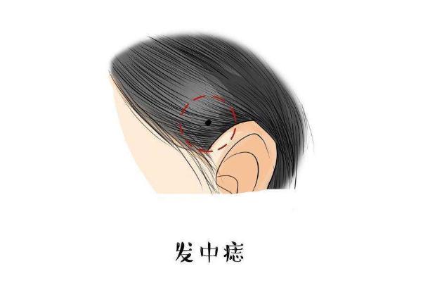 點(diǎn)痣要幾次才干凈 點(diǎn)痣要打麻藥嗎 點(diǎn)痣要幾次才干凈 點(diǎn)痣要打麻藥嗎