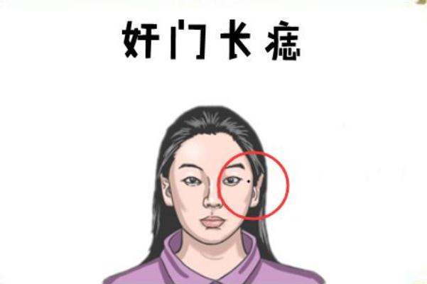 點(diǎn)痣有什么副作用 點(diǎn)痣有幾種方法 點(diǎn)痣有什么副作用 點(diǎn)痣有幾種方法