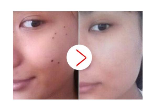 點痣留下的凹陷坑怎么修復(fù) 點痣多久可以恢復(fù)正常護(hù)膚 點痣留下的凹陷坑怎么修復(fù) 點痣多久可以恢復(fù)正常護(hù)膚