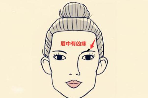 點痣會不會復(fù)發(fā) 點痣會留疤留坑嗎