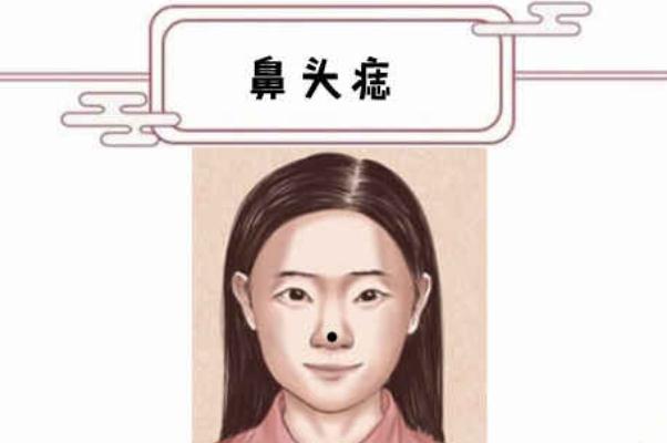 點(diǎn)痣有什么副作用 點(diǎn)痣有幾種方法 點(diǎn)痣有什么副作用 點(diǎn)痣有幾種方法