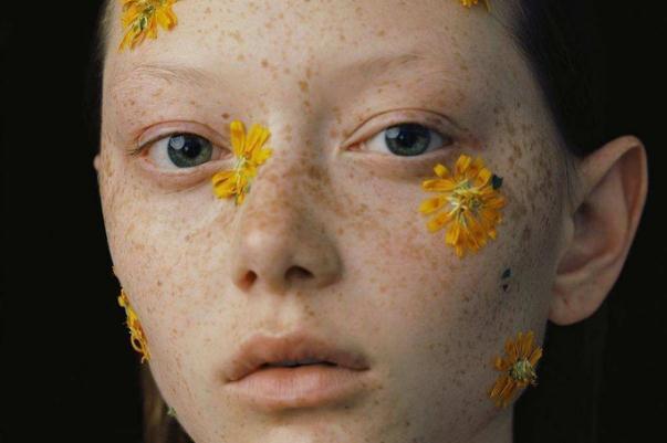 雀斑的形狀和顏色 雀斑的危害 雀斑的形狀和顏色 雀斑的危害