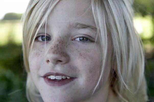 雀斑去除的最佳方法 雀斑能不能徹底根除 雀斑去除的最佳方法 雀斑能不能徹底根除