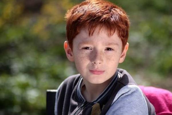 雀斑會(huì)變成黃褐斑嗎 雀斑會(huì)一直長(zhǎng)嗎 雀斑會(huì)變成黃褐斑嗎 雀斑會(huì)一直長(zhǎng)嗎