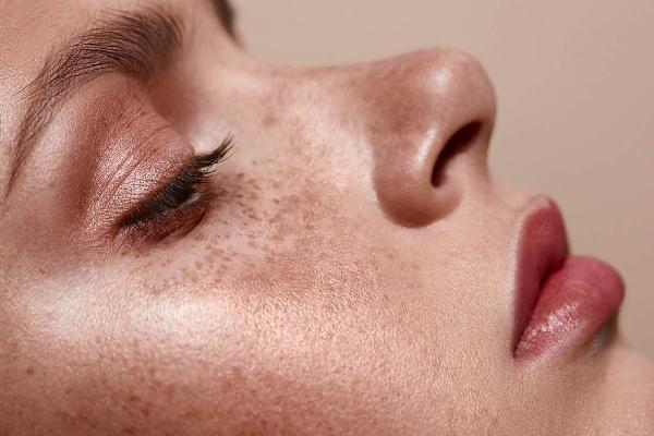 雀斑去除的最佳方法 雀斑能不能徹底根除 雀斑去除的最佳方法 雀斑能不能徹底根除