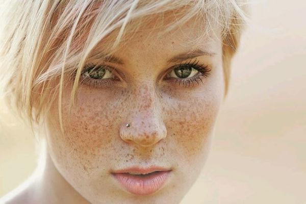 雀斑去除一般要多少錢 雀斑和黃褐斑有什么區(qū)別 雀斑去除一般要多少錢 雀斑和黃褐斑有什么區(qū)別