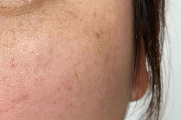 曬斑怎么去除掉 曬斑能徹底根除嗎 曬斑怎么去除掉 曬斑能徹底根除嗎