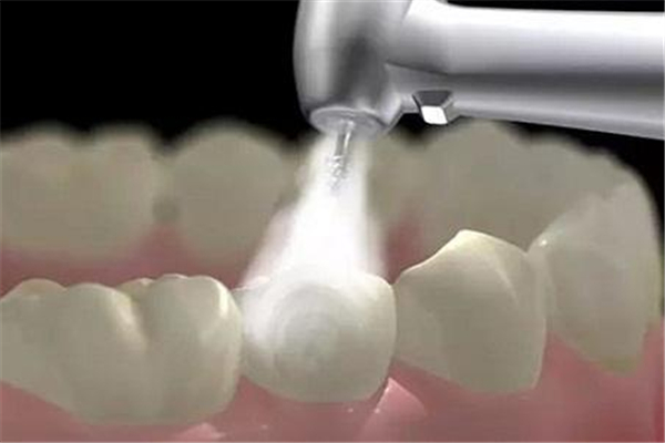 洗牙有必要洗牙根內(nèi)部嗎 洗牙洗的是什么 洗牙有必要洗牙根內(nèi)部嗎 洗牙洗的是什么