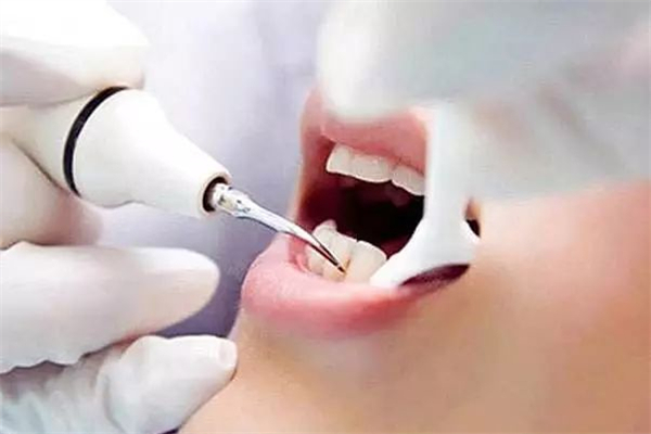 洗牙對牙齒有什么影響 洗牙可以除口臭嗎 洗牙對牙齒有什么影響 洗牙可以除口臭嗎