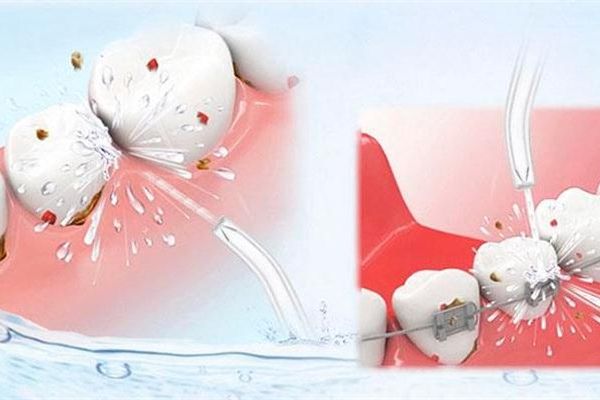 洗牙會(huì)造成牙齒松動(dòng)嗎 洗牙會(huì)損害牙齒嗎 洗牙會(huì)造成牙齒松動(dòng)嗎 洗牙會(huì)損害牙齒嗎