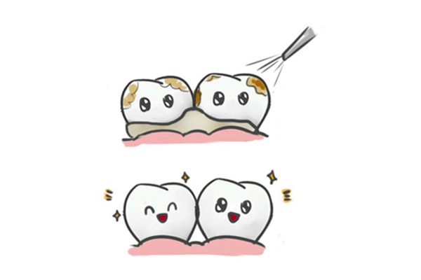 洗牙后牙齒縫隙變大怎么辦 洗牙后牙縫大怎么修補 洗牙后牙齒縫隙變大怎么辦 洗牙后牙縫大怎么修補