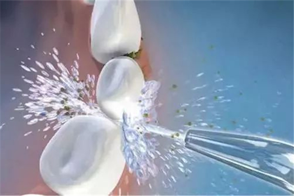 洗牙要多長時間 洗牙會導(dǎo)致牙齦萎縮嗎 洗牙要多長時間 洗牙會導(dǎo)致牙齦萎縮嗎