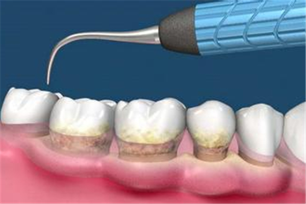 洗牙會(huì)造成牙齒松動(dòng)嗎 洗牙會(huì)損害牙齒嗎 洗牙會(huì)造成牙齒松動(dòng)嗎 洗牙會(huì)損害牙齒嗎