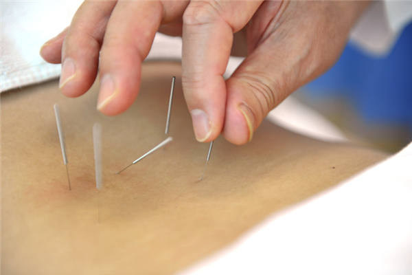 針灸會痛嗎 針灸有多疼 針灸會痛嗎 針灸有多疼