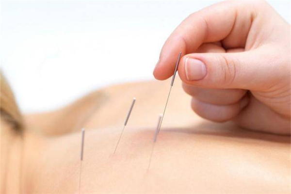 針灸對(duì)腰間盤(pán)突出有用嗎 針灸是什么原理治病