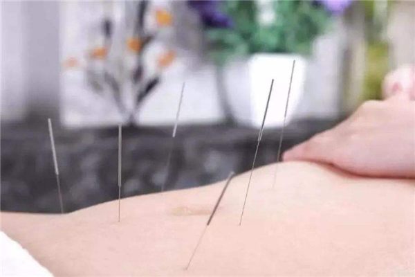 針灸要扎多久 針灸要注意哪些事項(xiàng) 針灸要扎多久 針灸要注意哪些事項(xiàng)