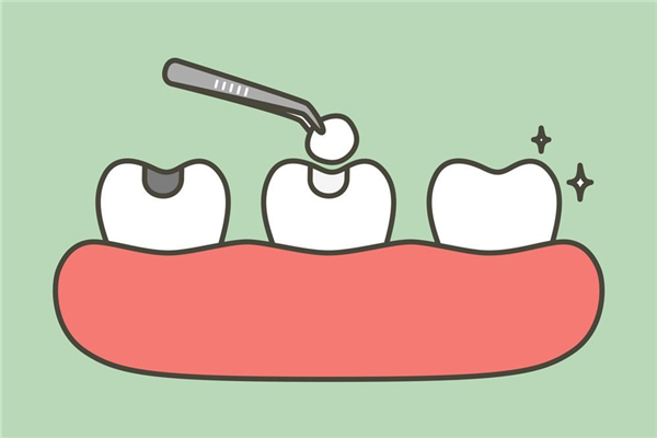 補(bǔ)牙多少錢一顆 補(bǔ)牙要注意什么 補(bǔ)牙多少錢一顆 補(bǔ)牙要注意什么