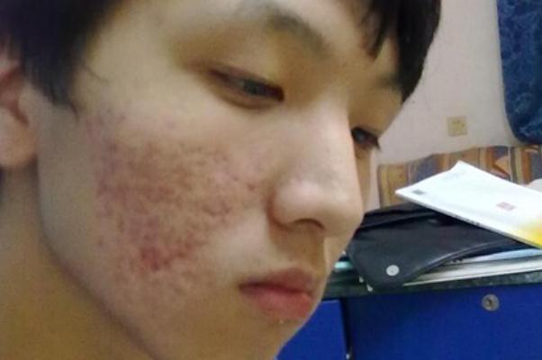 青春痘怎么快速消除 青春痘一般多久會(huì)消失 青春痘怎么快速消除 青春痘一般多久會(huì)消失