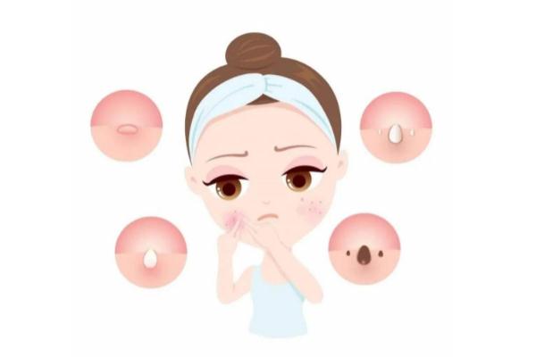 青春痘有哪幾種類型 青春痘有膿包怎么辦 青春痘有哪幾種類型 青春痘有膿包怎么辦
