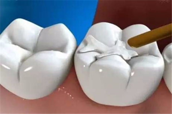 補(bǔ)牙多少錢一顆 補(bǔ)牙要注意什么 補(bǔ)牙多少錢一顆 補(bǔ)牙要注意什么