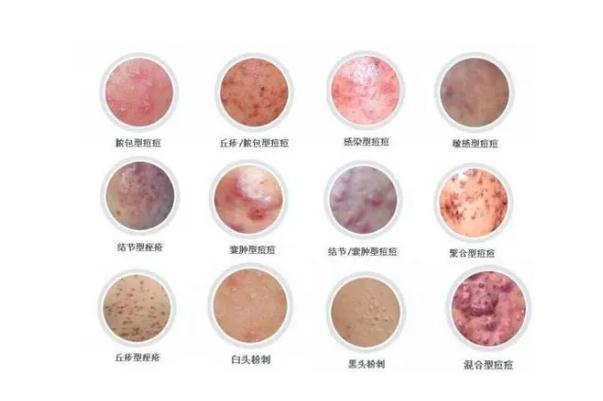 青春痘怎么快速消除 青春痘一般多久會(huì)消失 青春痘怎么快速消除 青春痘一般多久會(huì)消失