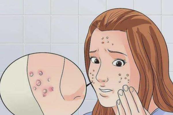 青春痘會(huì)長(zhǎng)在哪些部位 青春痘會(huì)長(zhǎng)在背上嗎