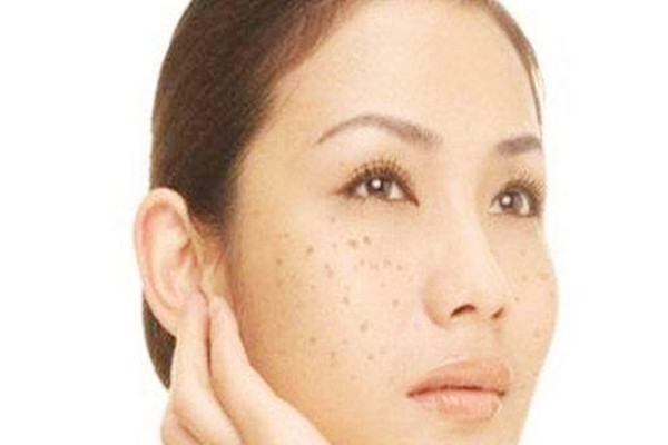 玫瑰花能去除黃褐斑嗎 蜂王漿能去除黃褐斑嗎 玫瑰花能去除黃褐斑嗎 蜂王漿能去除黃褐斑嗎