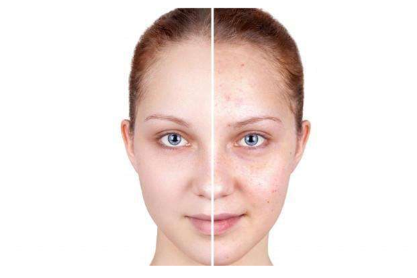 粉刺是怎么產(chǎn)生的 粉刺是什么樣子 粉刺是怎么產(chǎn)生的 粉刺是什么樣子