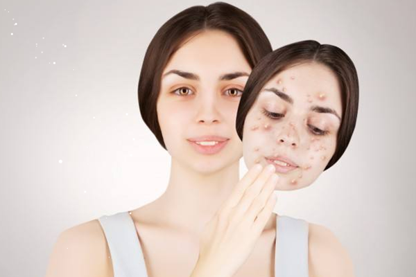 粉刺是怎么產(chǎn)生的 粉刺是什么樣子 粉刺是怎么產(chǎn)生的 粉刺是什么樣子