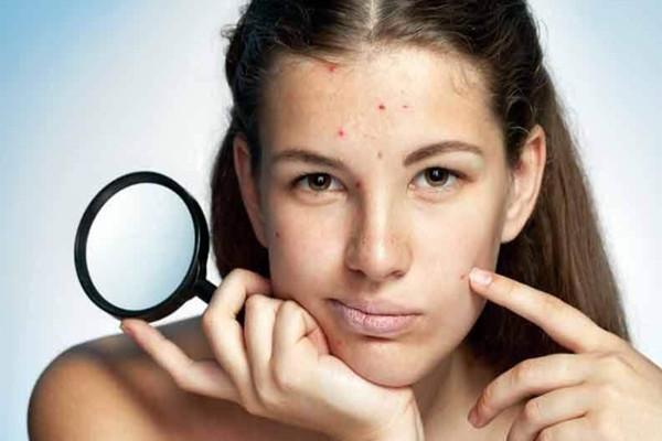 有粉刺可以化妝嗎 有粉刺可以刷酸嗎 有粉刺可以化妝嗎 有粉刺可以刷酸嗎
