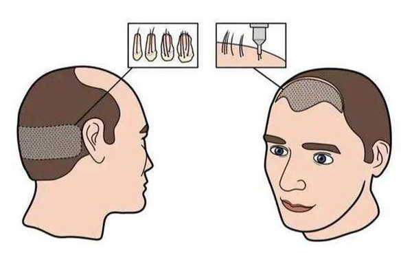 植發(fā)前需要做哪些準(zhǔn)備 植發(fā)前驗(yàn)血是要檢查什么 植發(fā)前需要做哪些準(zhǔn)備 植發(fā)前驗(yàn)血是要檢查什么