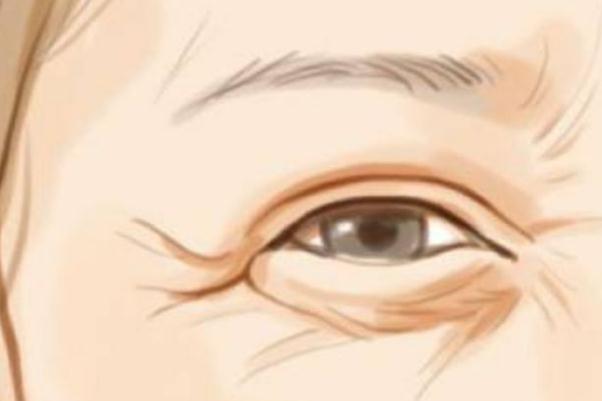 魚尾紋除皺針打一次能保持多久 魚尾紋除皺針有什么副作用 魚尾紋除皺針打一次能保持多久 魚尾紋除皺針有什么副作用