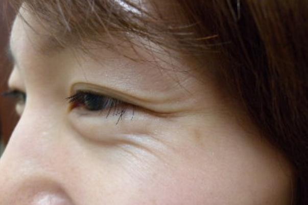 魚尾紋怎么才能去掉 魚尾紋是哪個(gè)部位 魚尾紋怎么才能去掉 魚尾紋是哪個(gè)部位