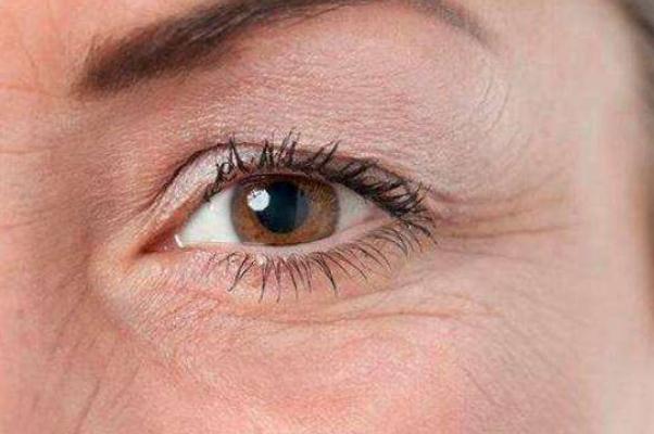 魚尾紋怎么才能去掉 魚尾紋是哪個(gè)部位 魚尾紋怎么才能去掉 魚尾紋是哪個(gè)部位