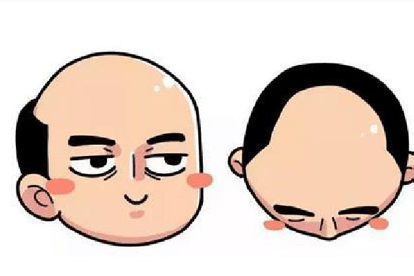 植發(fā)用的是哪里的毛囊 植發(fā)會不會有什么副作用 植發(fā)用的是哪里的毛囊 植發(fā)會不會有什么副作用