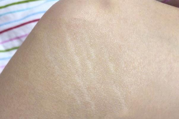 肥胖紋怎么去掉 肥胖紋紅色和白色哪個(gè)更嚴(yán)重 肥胖紋怎么去掉 肥胖紋紅色和白色哪個(gè)更嚴(yán)重