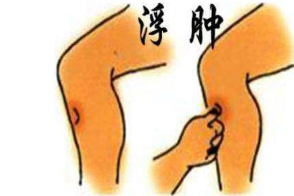 水腫是怎么引起的 水腫怎么治療最快 水腫是怎么引起的 水腫怎么治療最快