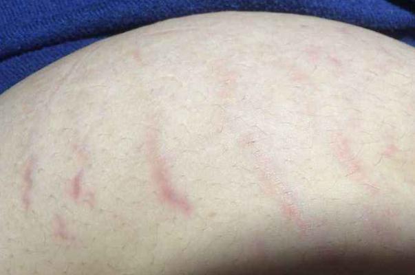 肥胖紋是橫的還是豎的 肥胖紋要多久才能完全消除嗎 肥胖紋是橫的還是豎的 肥胖紋要多久才能完全消除嗎