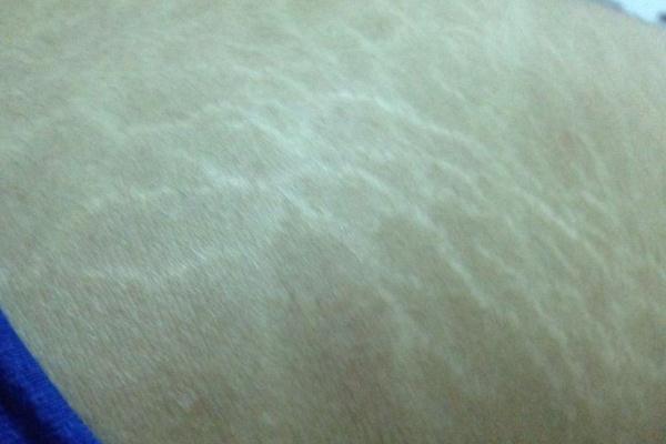 肥胖紋是橫的還是豎的 肥胖紋要多久才能完全消除嗎 肥胖紋是橫的還是豎的 肥胖紋要多久才能完全消除嗎