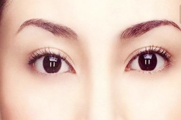 雙眼皮埋線會(huì)留疤嗎 雙眼皮埋線會(huì)增生嗎 雙眼皮埋線會(huì)留疤嗎 雙眼皮埋線會(huì)增生嗎