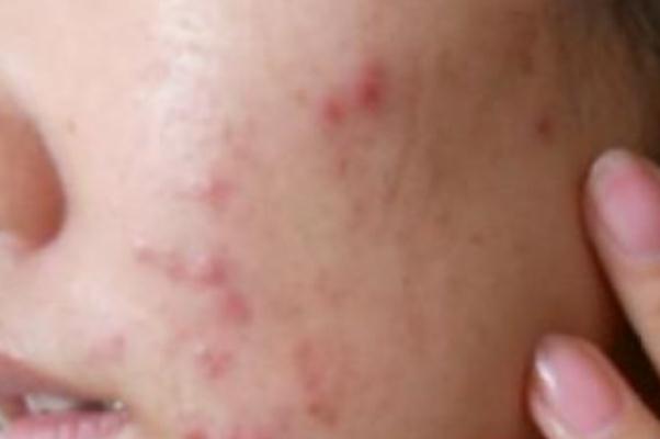 痘痘肌膚要涂防曬嗎 痘痘肌是先補水還是先祛痘 痘痘肌膚要涂防曬嗎 痘痘肌是先補水還是先祛痘