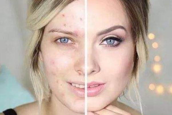 痘痘肌膚有哪幾種類型 痘痘肌膚有什么特征 痘痘肌膚有哪幾種類型 痘痘肌膚有什么特征